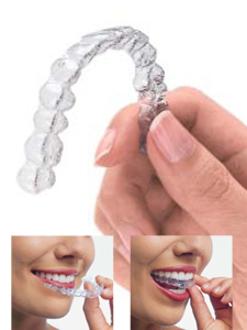 Invisalign