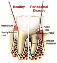 Periodontitis