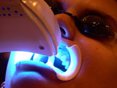 Whitening